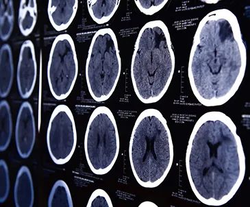 Neurosurgury 4